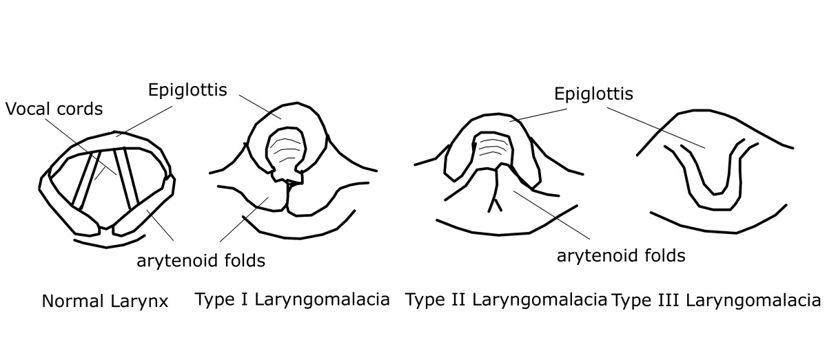The three main types of laryngomalacia, as compared to a normal glottis.