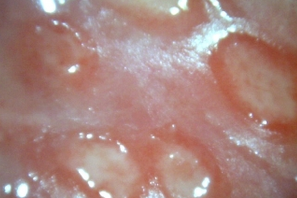 Genital (vaginal) herpes may look something like this. There may be itching, burning, or tingling sensations and painful blisters that turn into sores. Some people experience fever, body aches, and swollen lymph nodes.