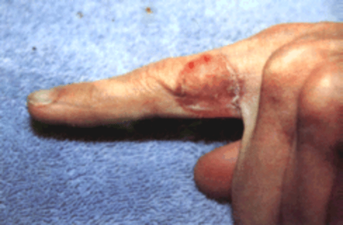 Ringworm or fungal infection on finger