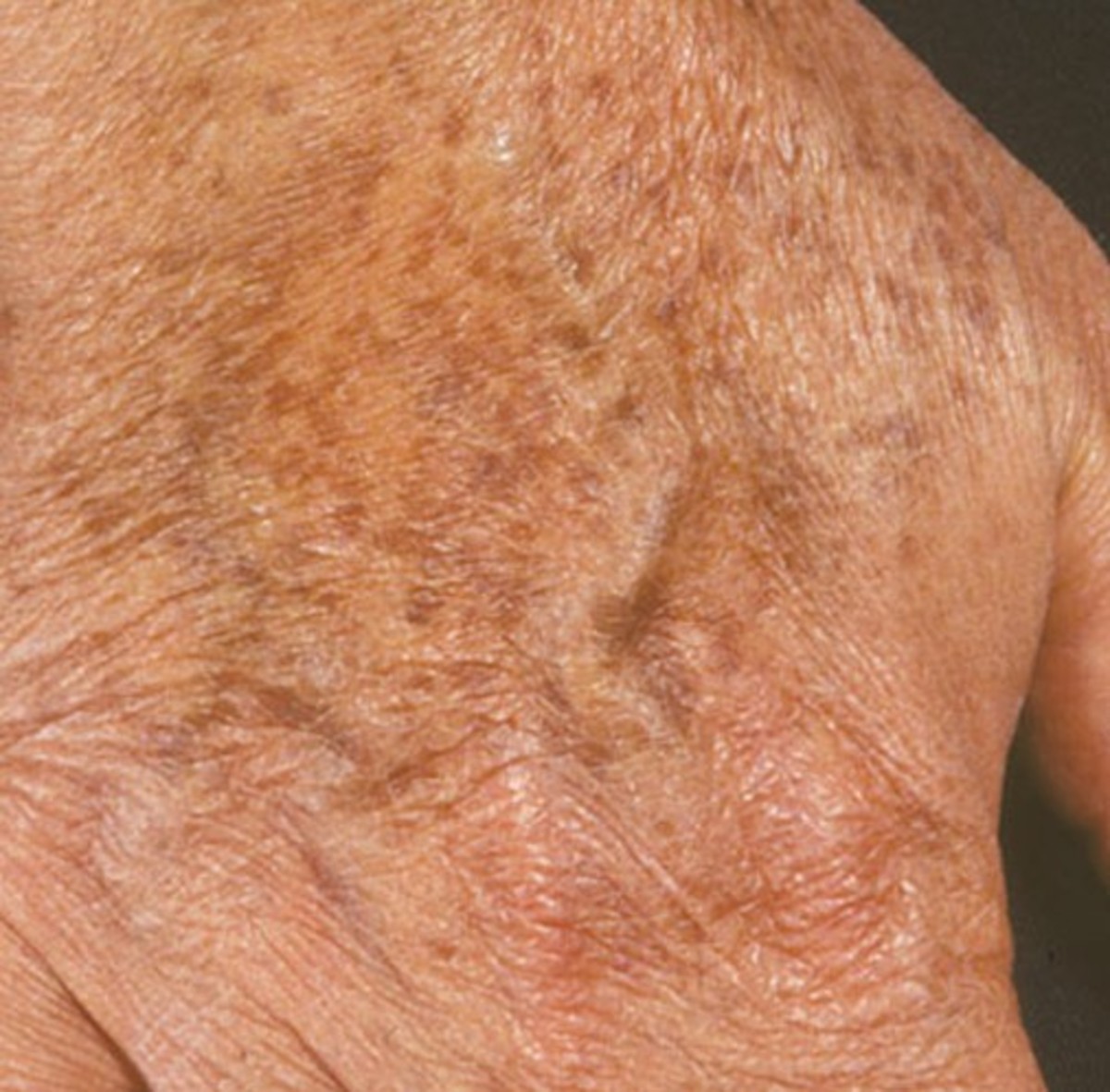 Liver spots on the hand
