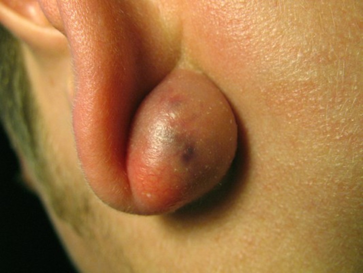 A growth on the earlobe.