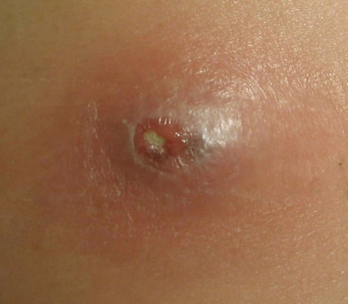 spider-bites-pictures-symptoms-and-treatment