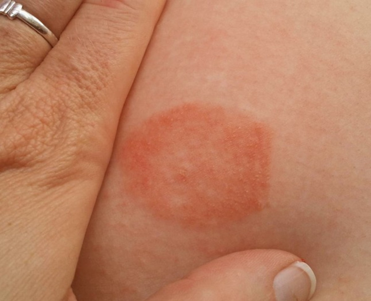 spider-bites-pictures-symptoms-and-treatment