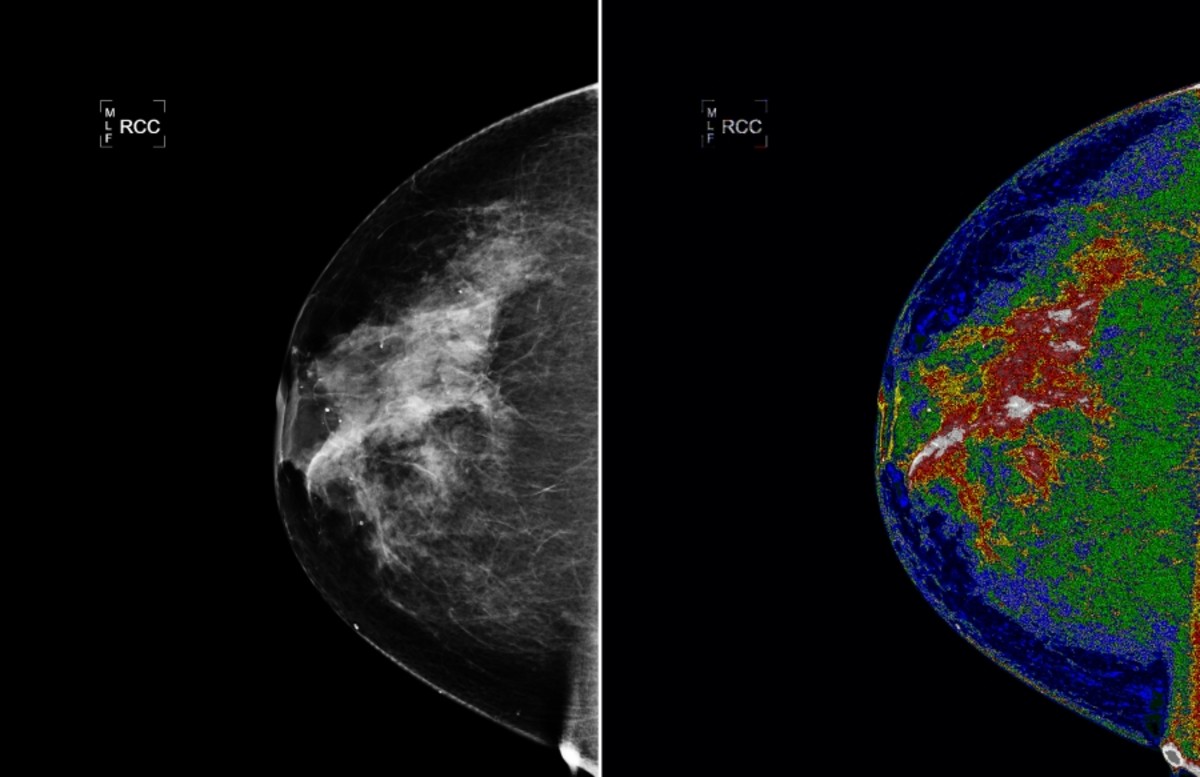 Microcalcifications And Stereotactic Biopsy—do What You Gotta Do Hubpages