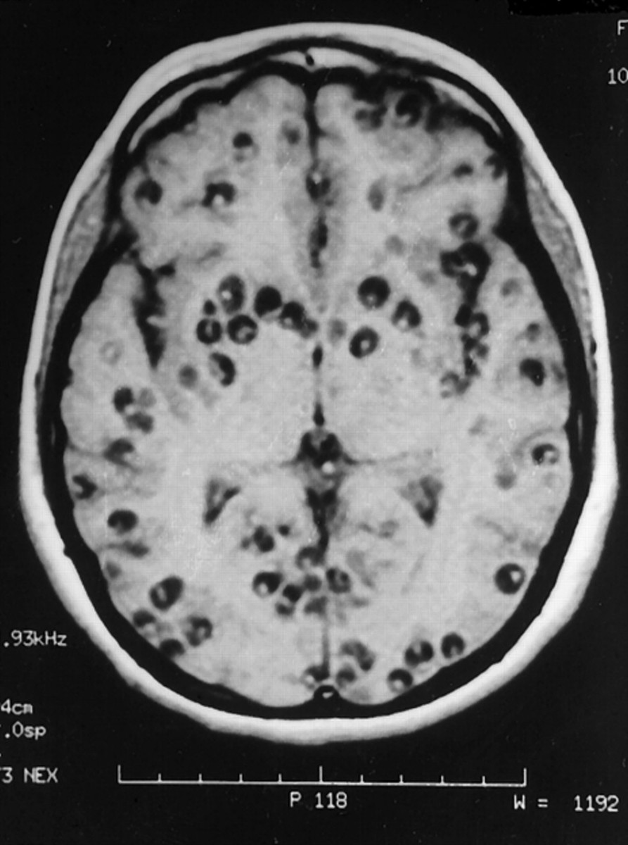 This brain scan shows the cysts caused by cysticercosis.