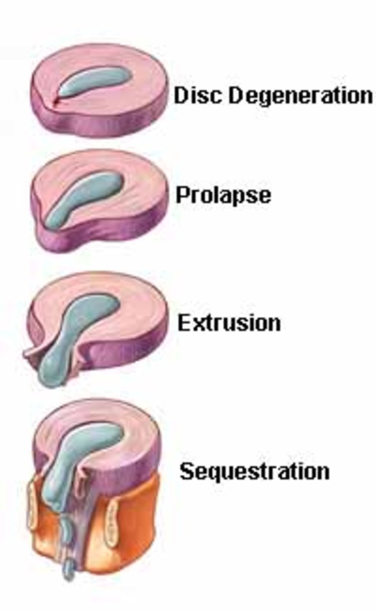 Sciatica Causes, Symptoms, and Treatment YouMeMindBody