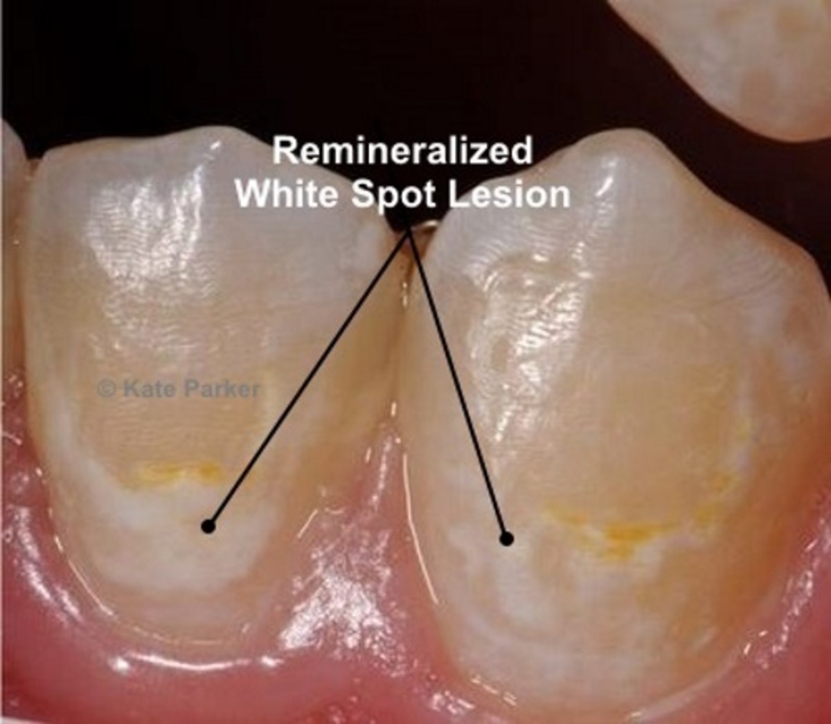 Remineralized white spot lesions 
