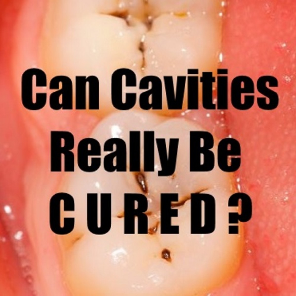Can cavities be cured? Find out in this article. 