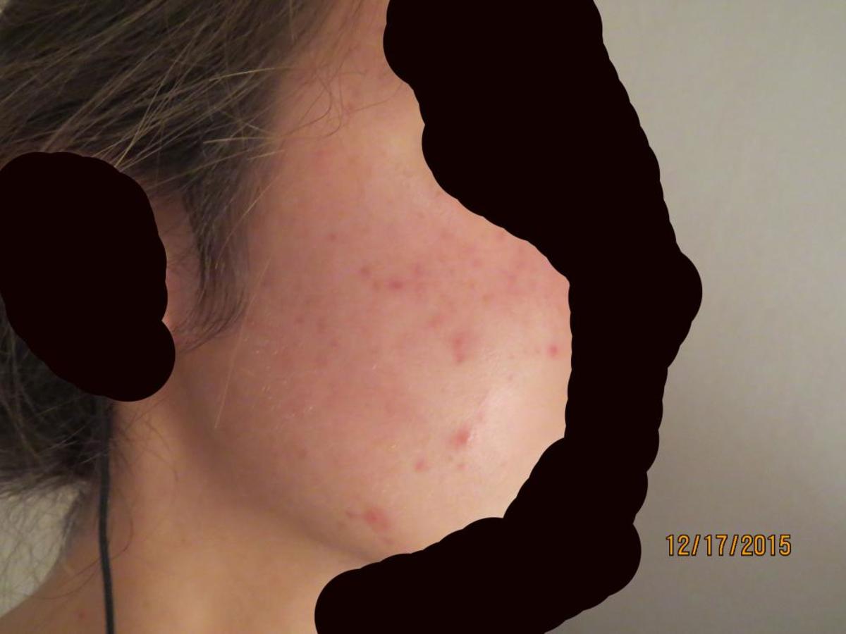 My Experience With Accutane for Acne: The Female Perspective