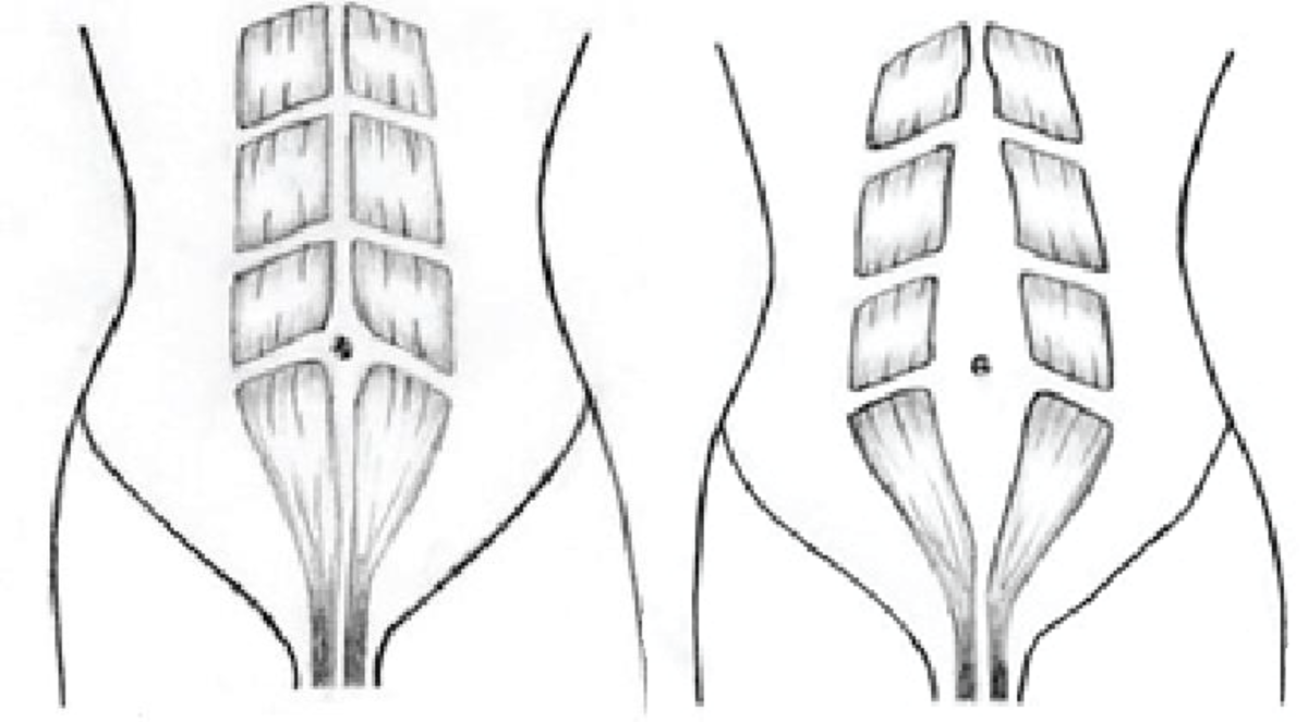 post-partum-diastasis-recti