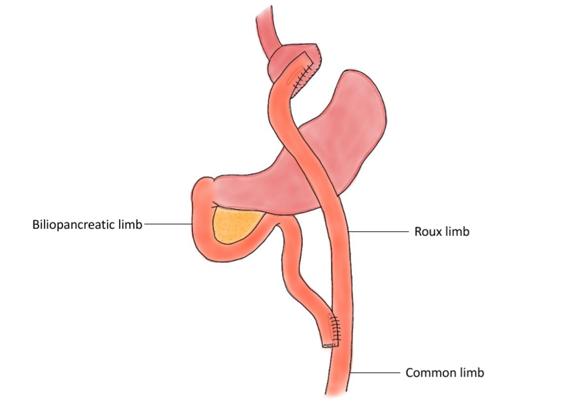 Diagram of a Roux-en-Y gastric bypass.