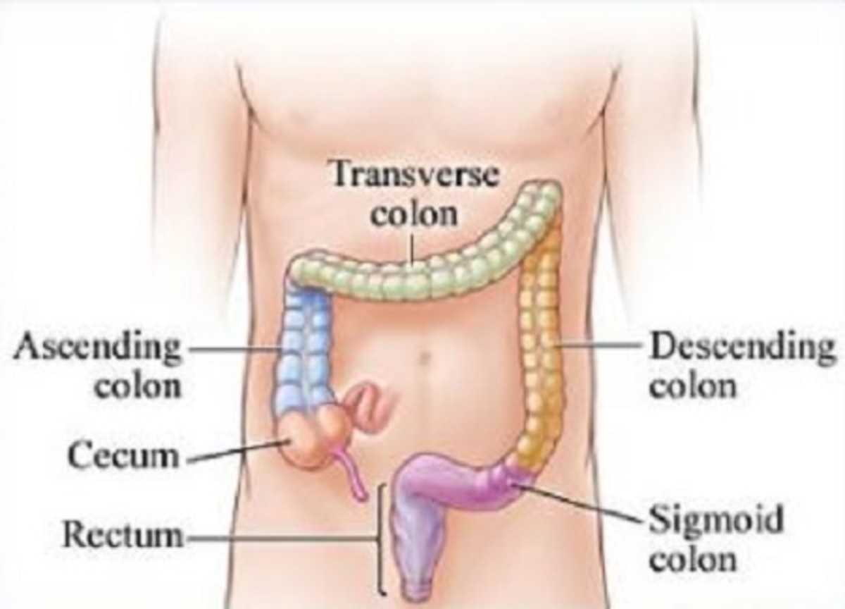 Prevent Colon Cancer by Blocking Growth of Colon Polyps (A True Experience)