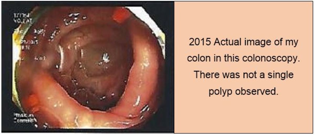 prevent-colon-polyps-