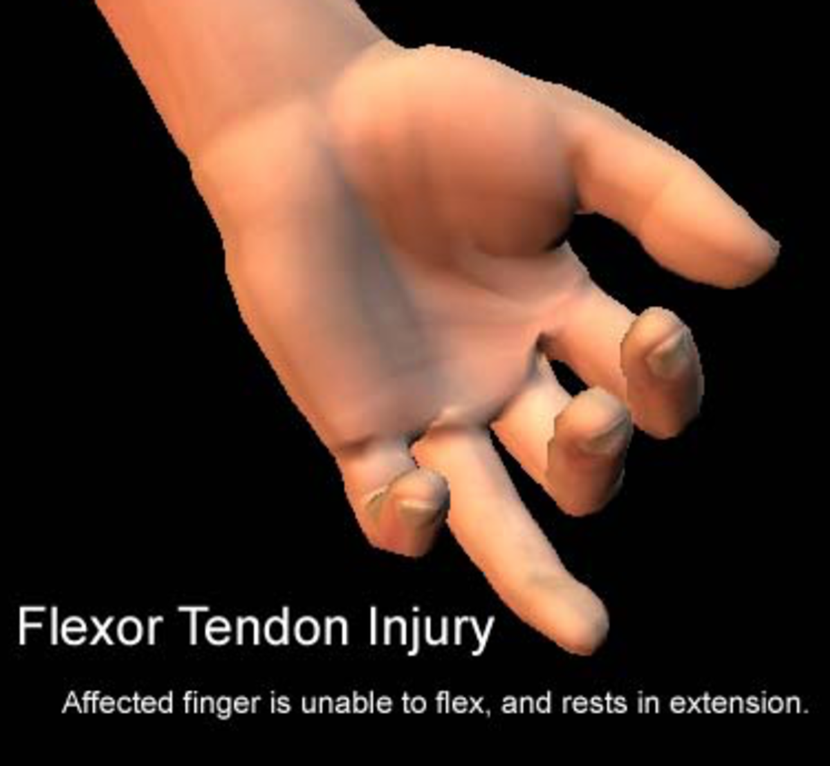 A finger with a tendon injury lying flat while other fingers retain their natural cascade.