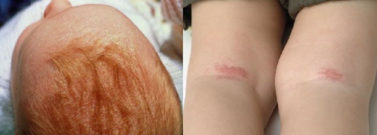 how-to-handle-eczema-in-children