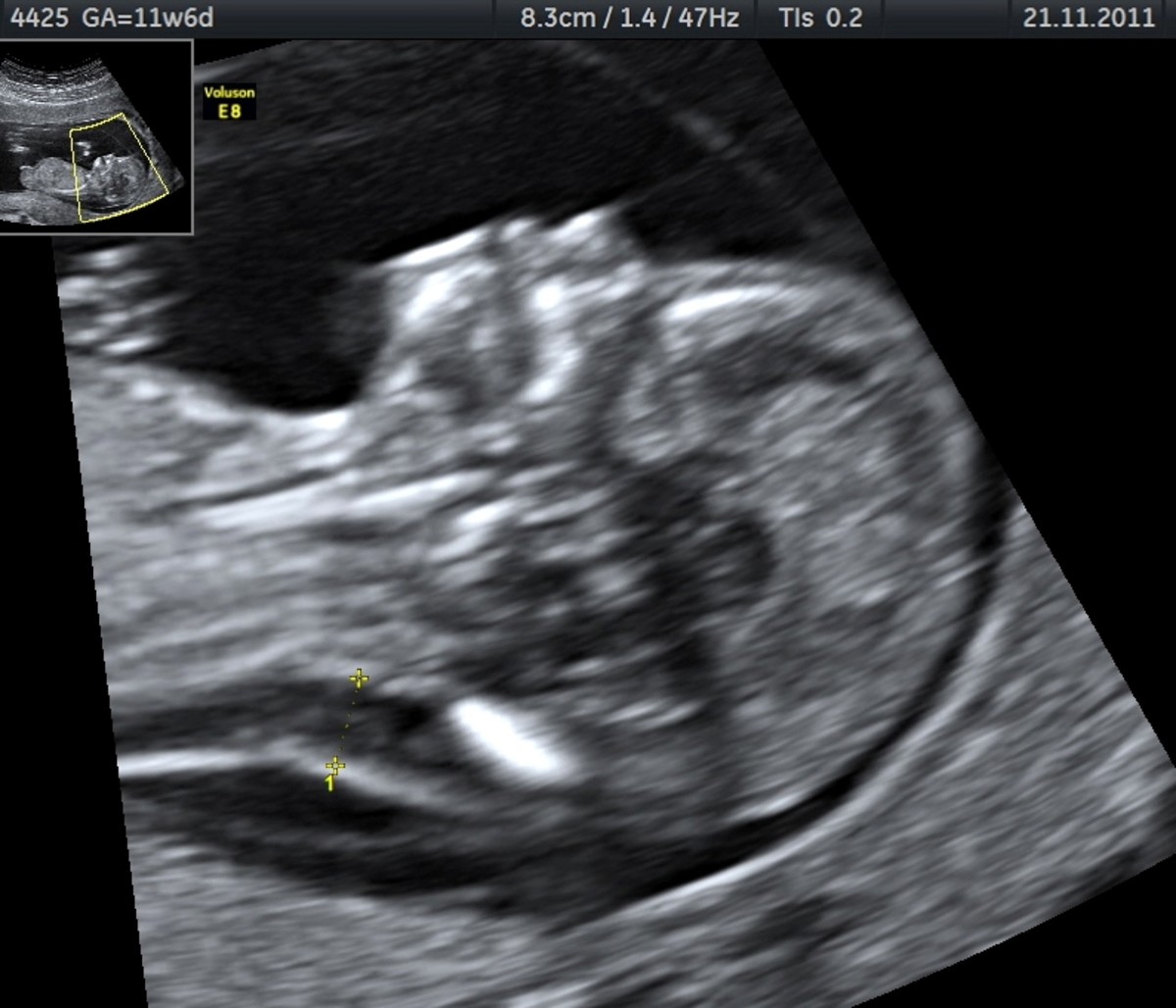 Edema in the nuchal fold and an absence of a nasal bone are observed in this ultrasound at 11 weeks of gestation. This baby has Trisomy 21 (Down Syndrome), as confirmed by Chorionic Villus Sampling testing. 