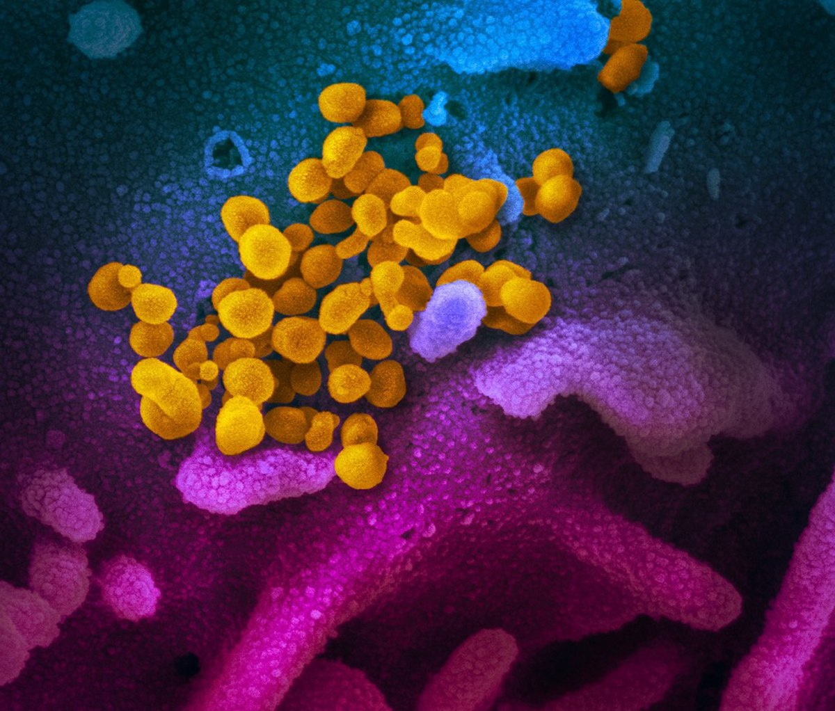 Coronavirus (yellow) emerging from a human cell in the body.