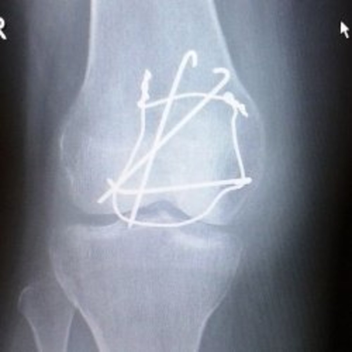 The X-ray of my fractured knee