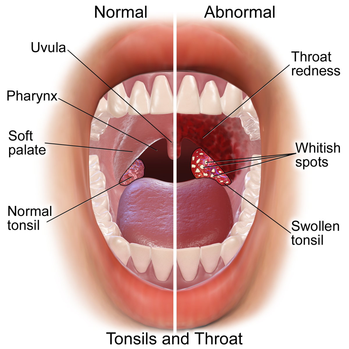how-to-cure-tonsilitis