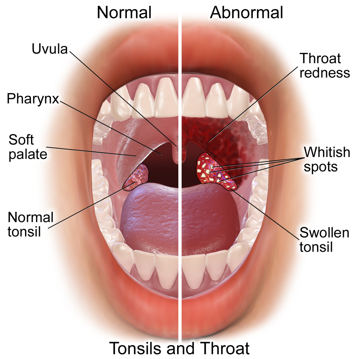 How I Treated My Chronic Tonsillitis Patient s Lounge