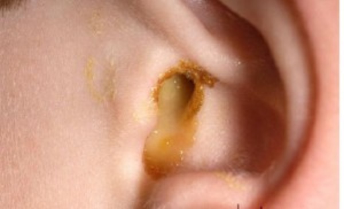 Ear Infection Prevention and Treatment