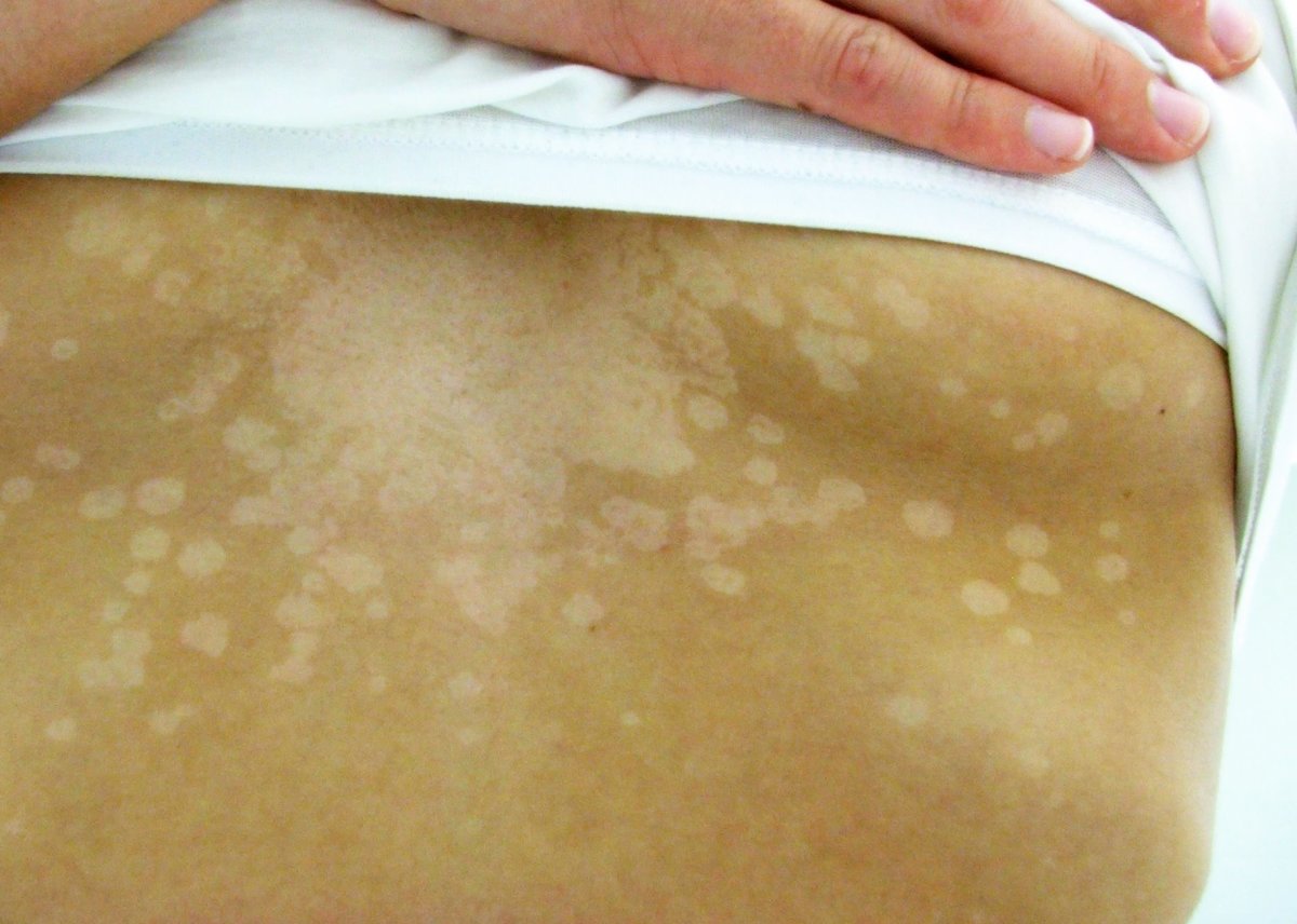 Pale patches on the chest caused by tinea versicolor.