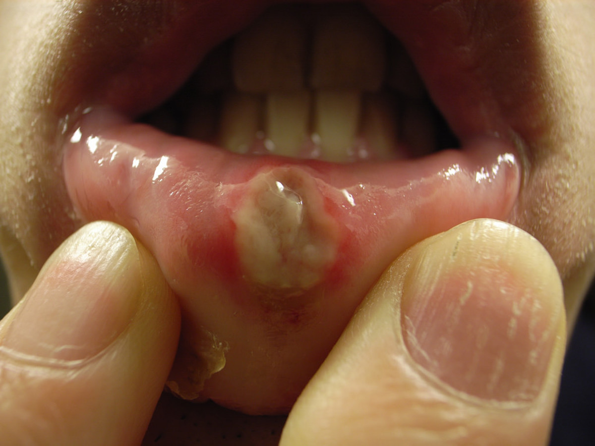 Natural Home Remedies for Canker Sores
