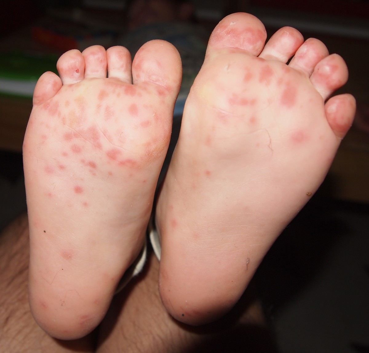Hand, foot, and mouth disease can cause blisters on the feet, causing some discomfort when walking