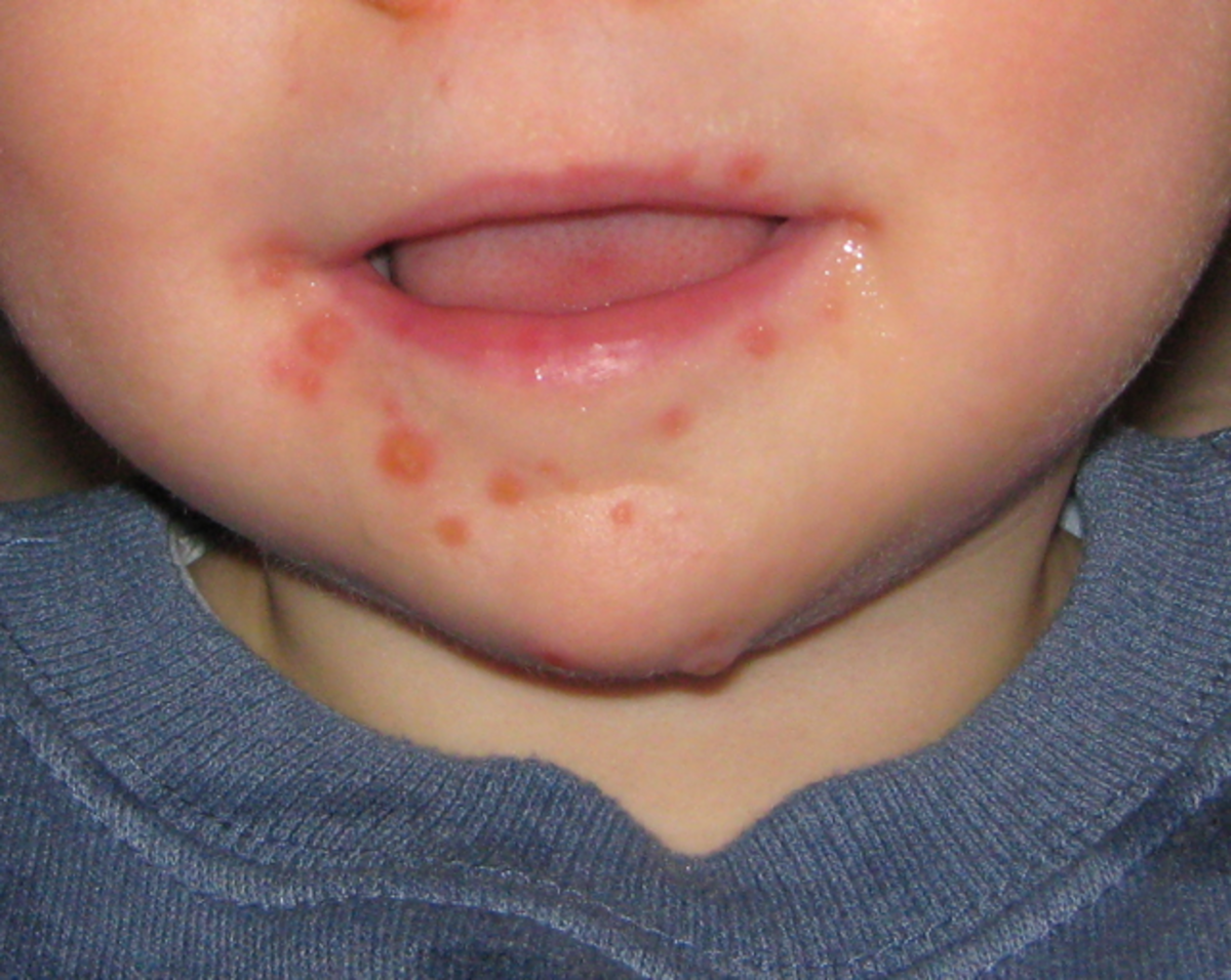Hand, foot, and mouth disease will cause blisters to form on the face, hands, and feet