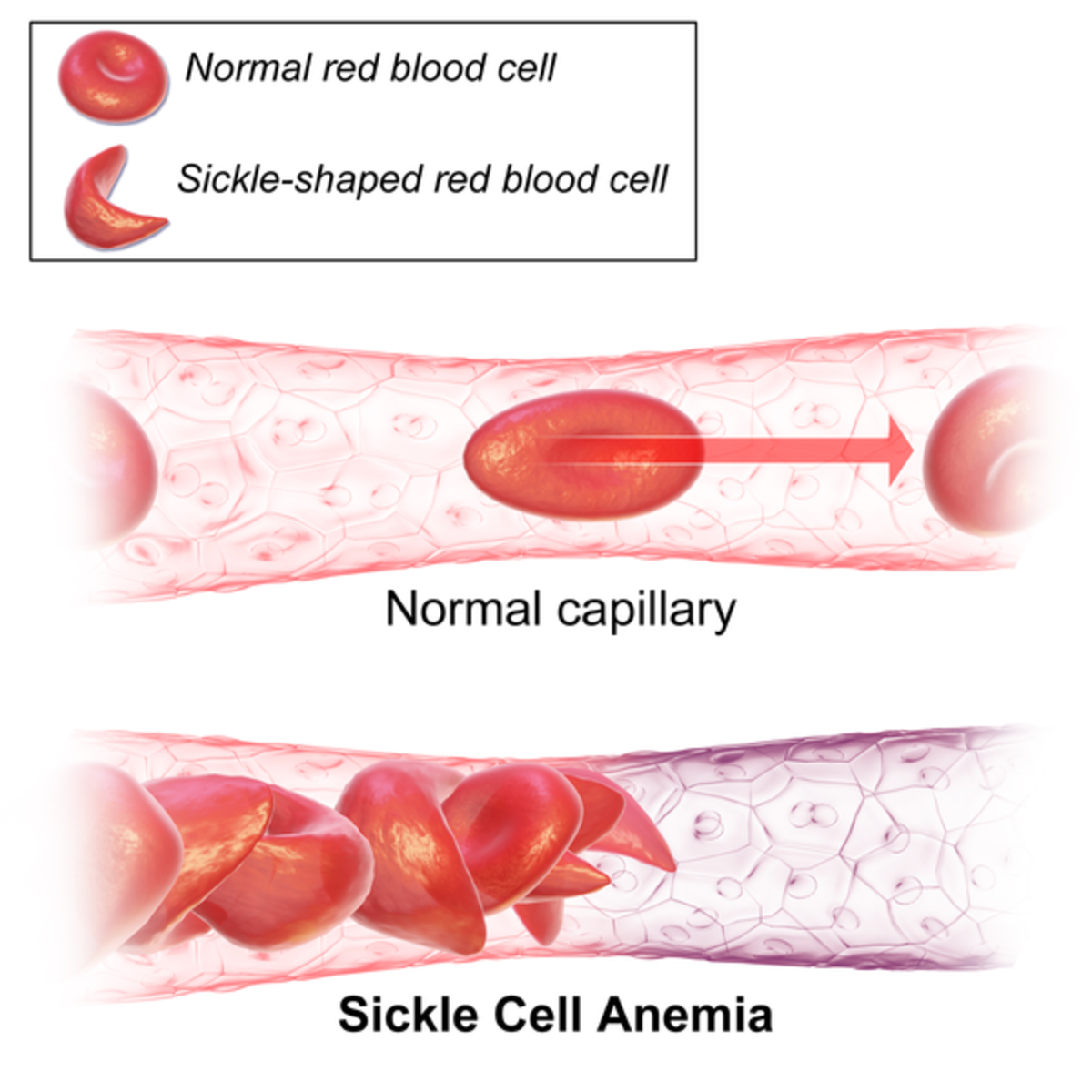 Sickle Cell Disease Or Anemia And CRISPR Cas Genome Editing Owlcation