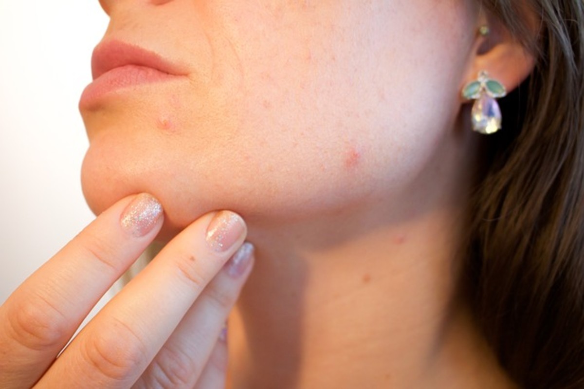 Is acne a sign of pregnancy?