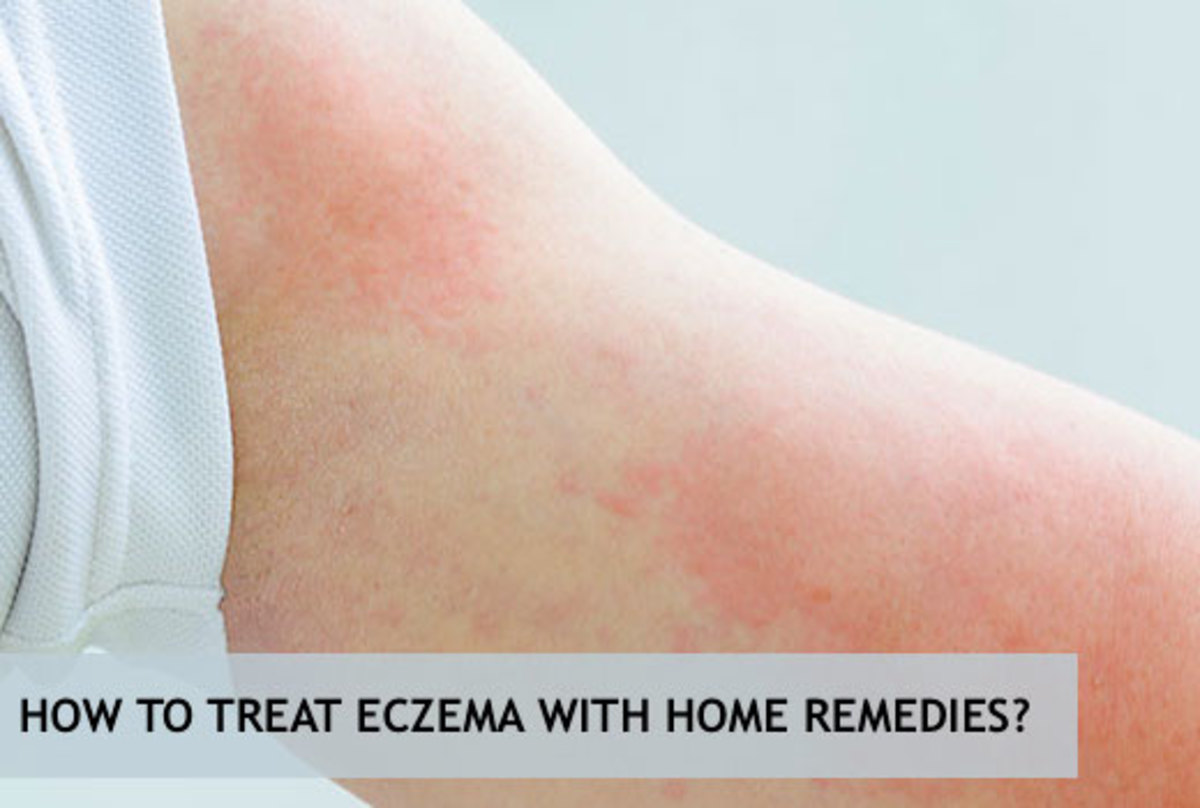 Eczema is any superficial inflammatory process that involves the epidermis and is characterized by itching, scaling, redness, etc.