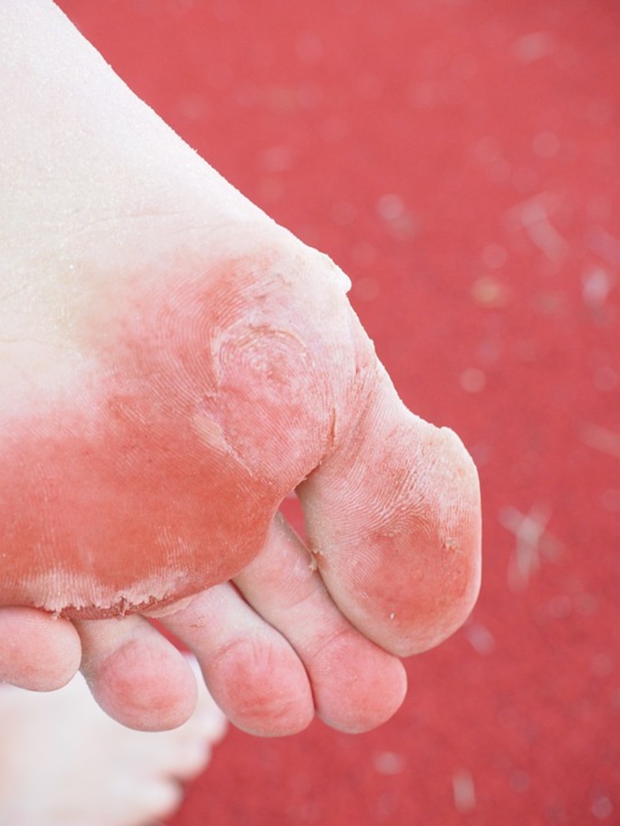 Home Remedies for Stinky Feet