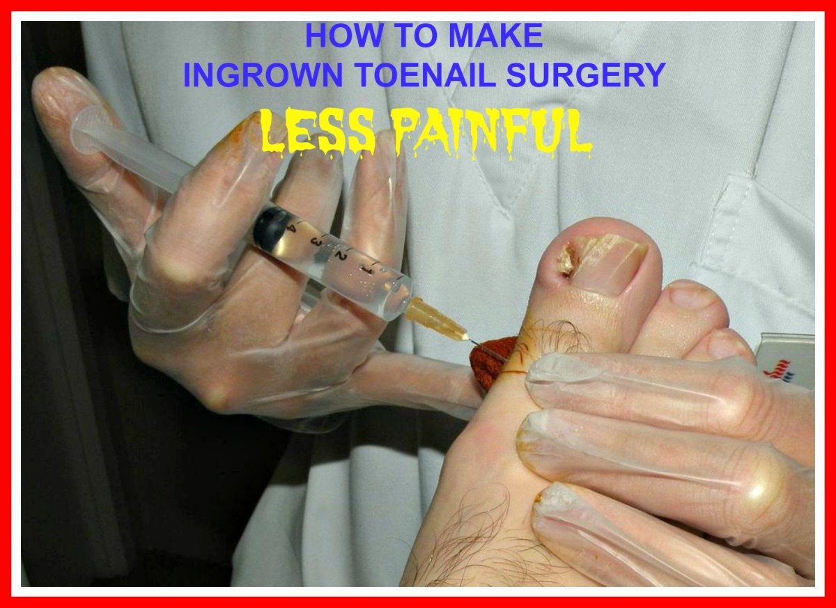 How to Make Ingrown Toenail Surgery Less Painful