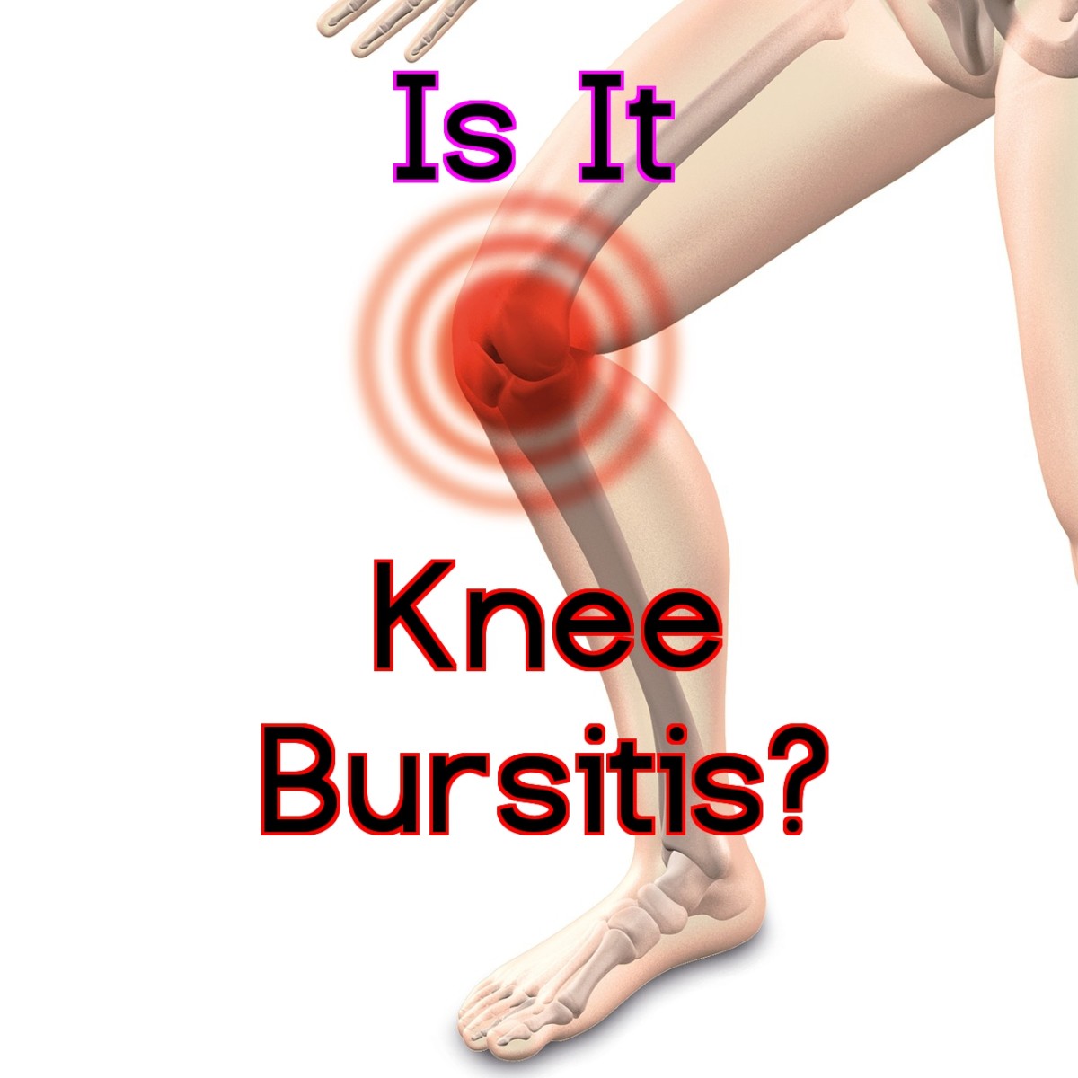 Is it knee bursitis?