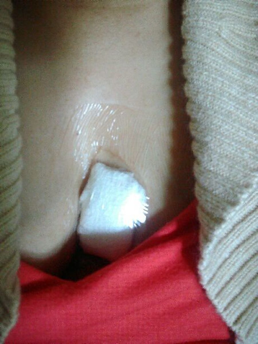 After the surgery, a small bandage was placed over the surgical site.  I was unable to shower the first day, and unable to get the area wet for at least 4 days.  