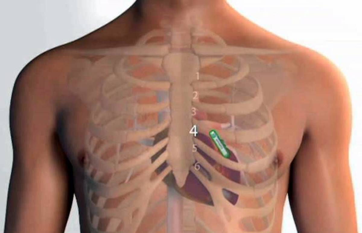 implanted heart monitor