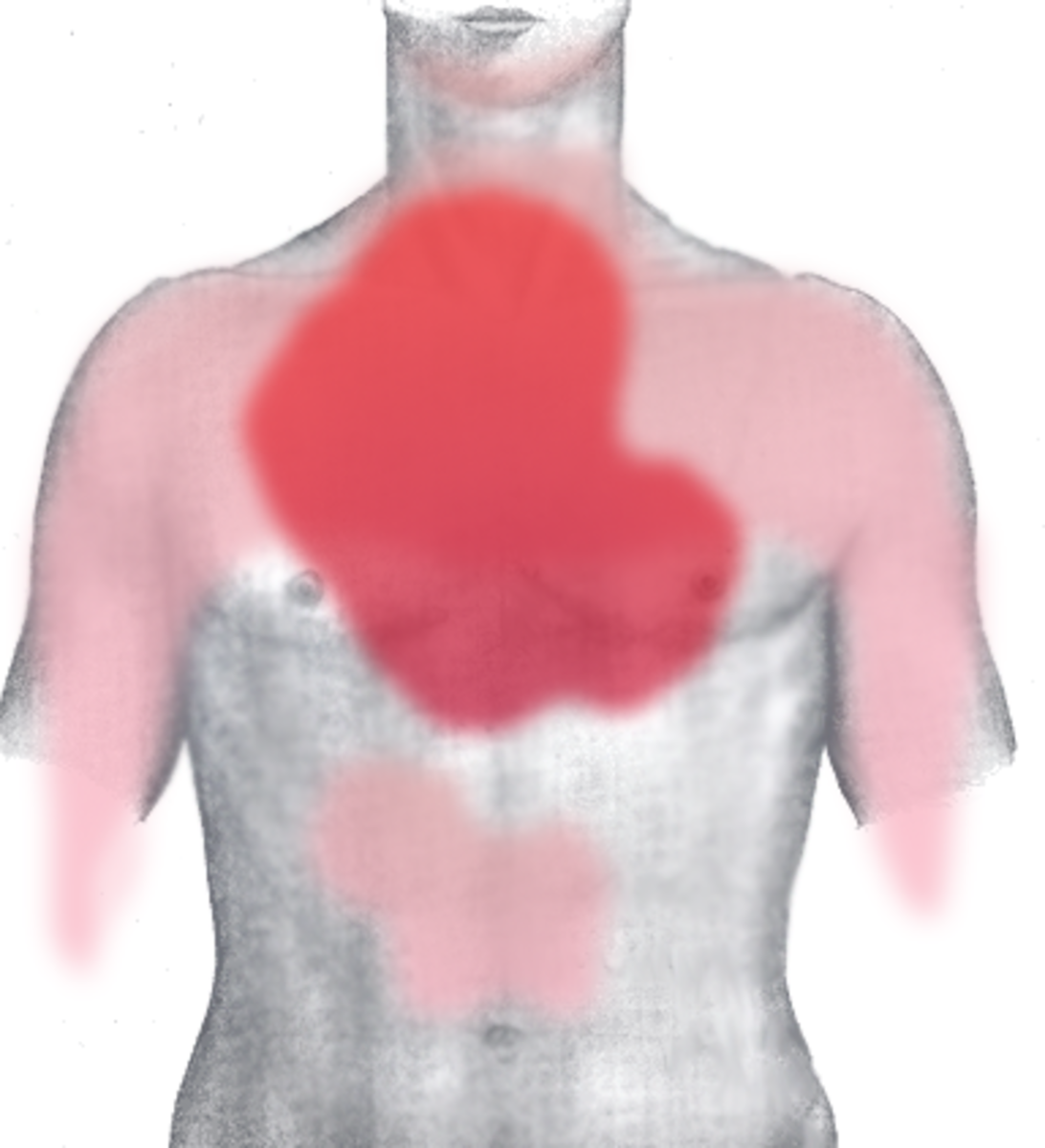 Rough diagram of pain zones in myocardial infarction; dark red: most typical area, light red: other possible areas; view of the chest 
