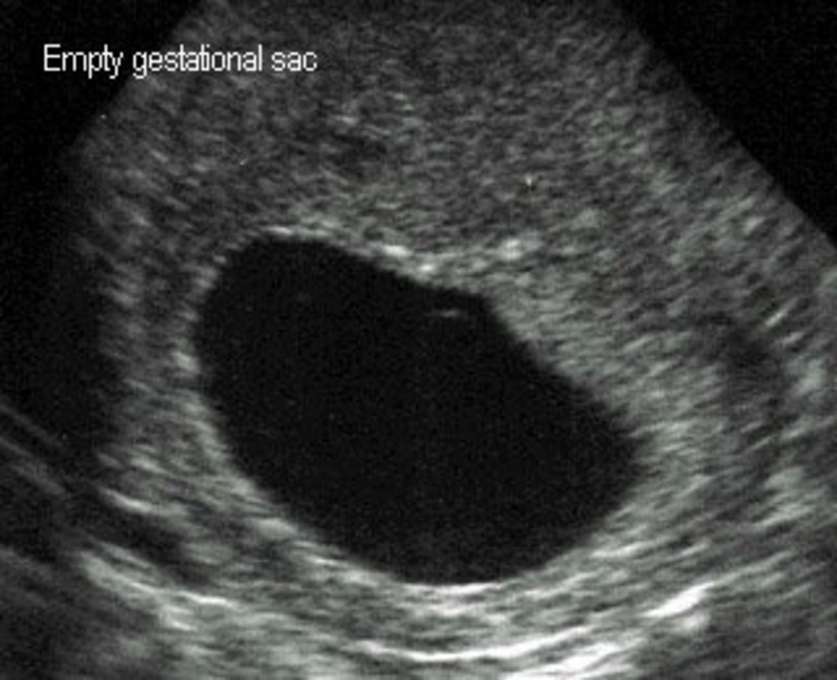 This is not my ultrasound picture, but this is what the doctor will see if you have a blighted ovum. There is an empty gestational sac with no  yolk sac or fetus visible. 
