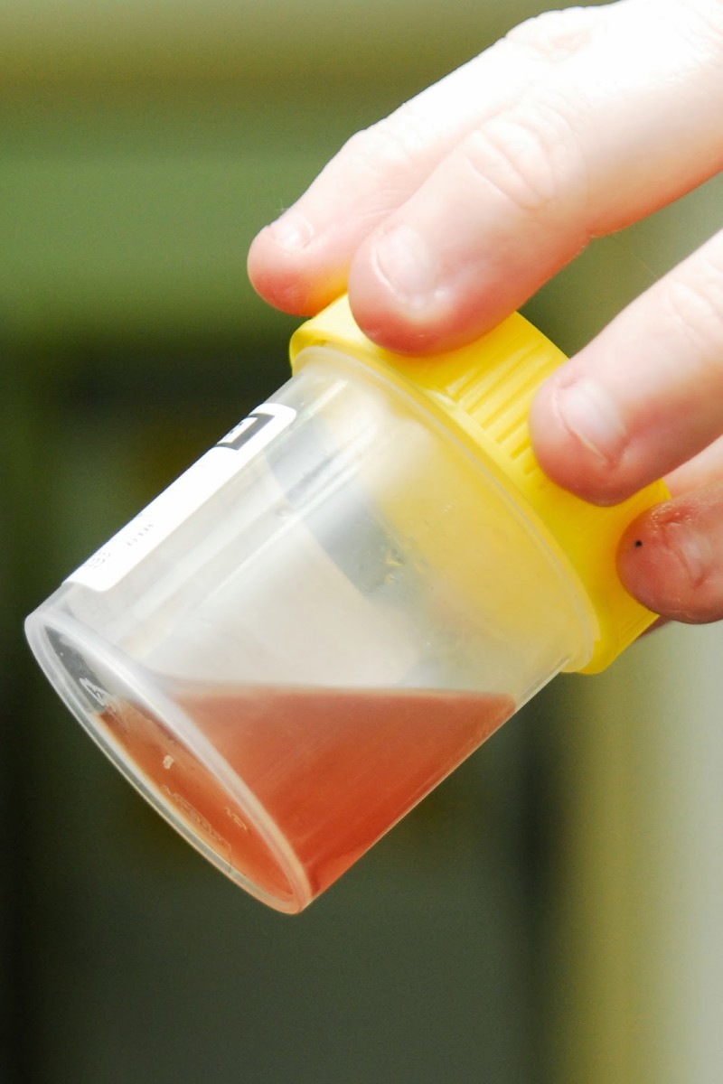 The urine sample seen here is discolored due to the presence of blood. 