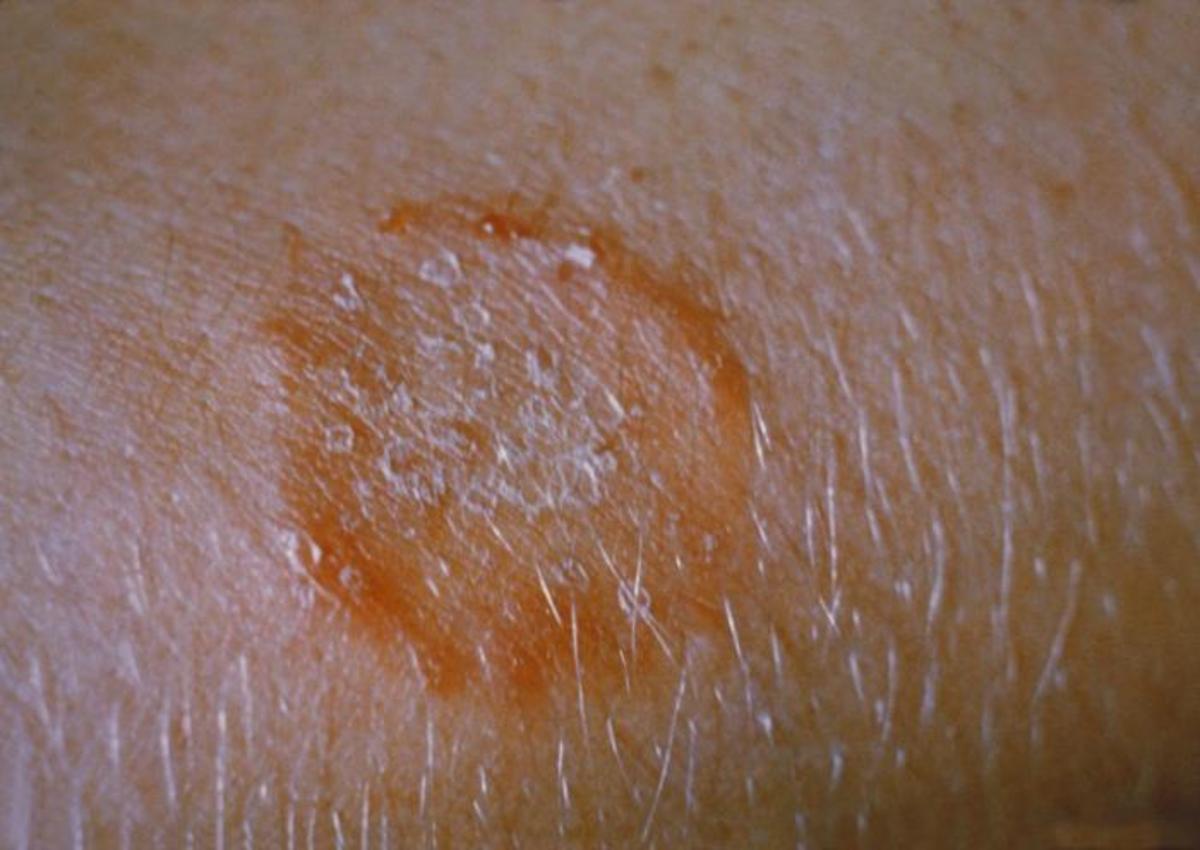 Ringworm rash on the arm.