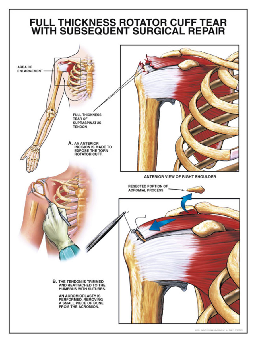 How to Fix a Torn Shoulder Strap - Lollipuff