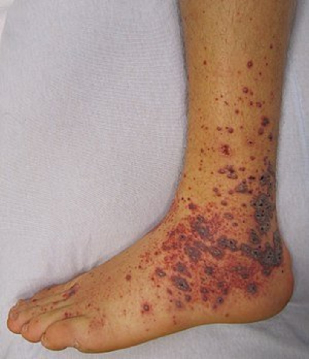 Petechia/purpura on the lower limb due to medication-induced vasculitis