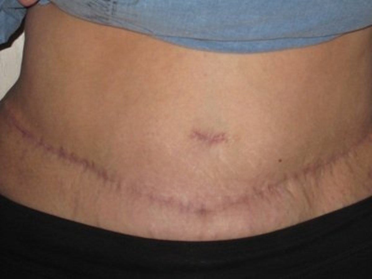 Belly button is healed. Waist scar is pink, healed, a little bumpy, softening up over time.