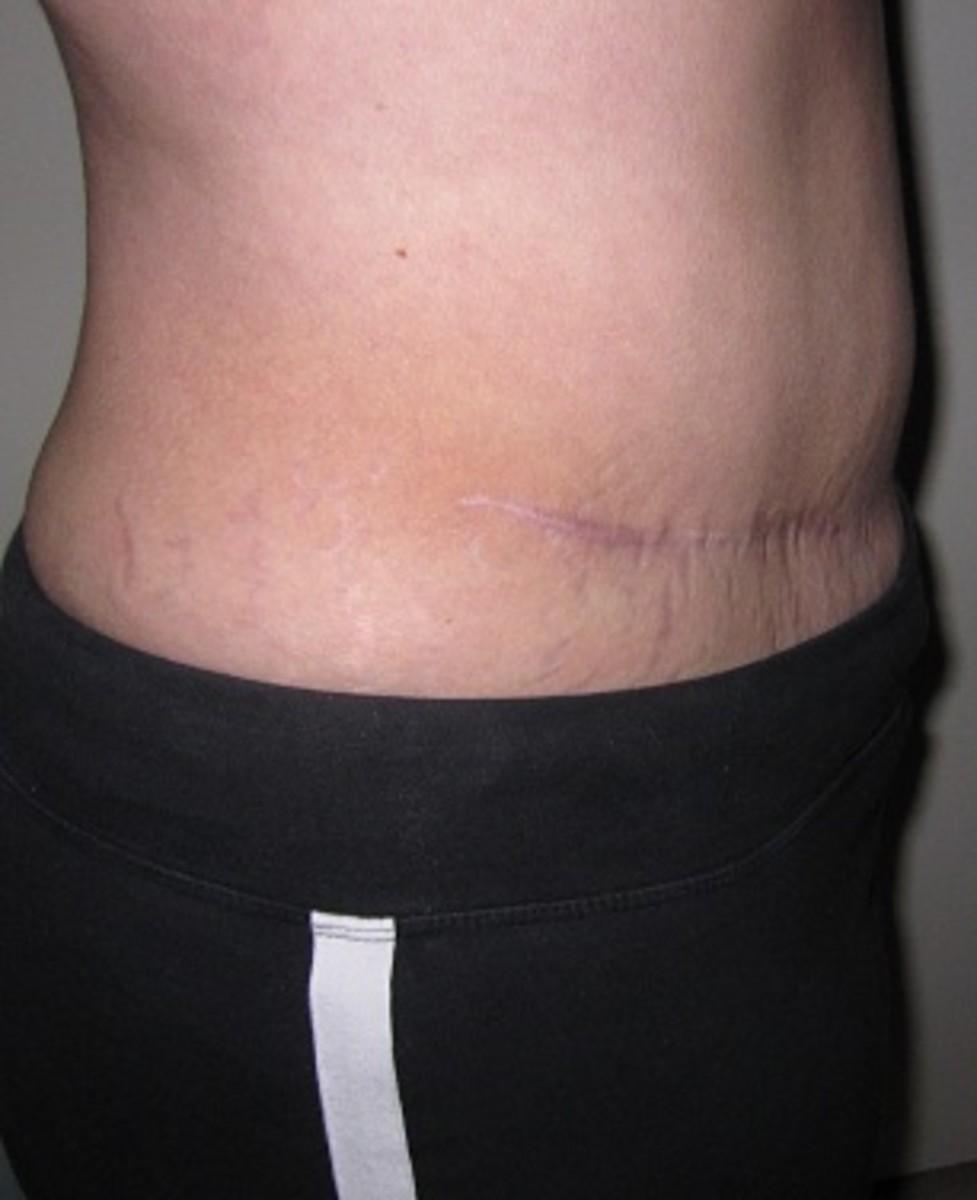 Profile view, right hip (11 months following TRAM surgery) 