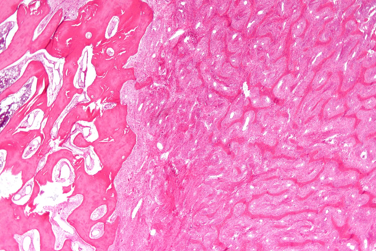 Micrograph of fibrous dysplasia (right) juxtaposed with unaffected bone (left).