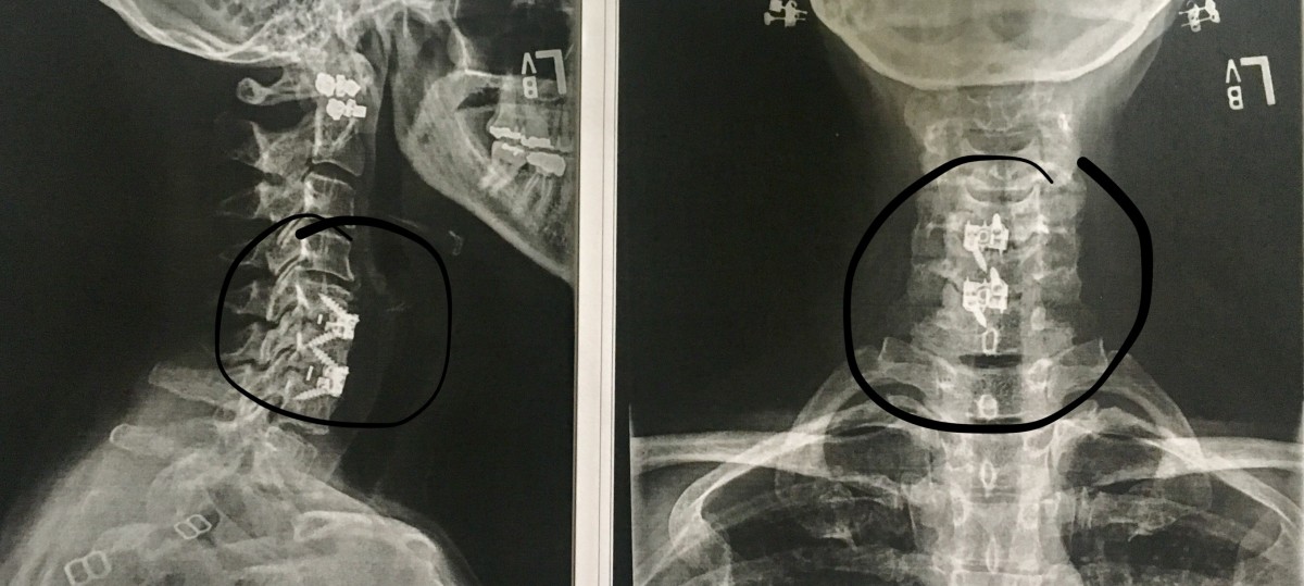 Post-Operative X-rays of the Healing Fusion