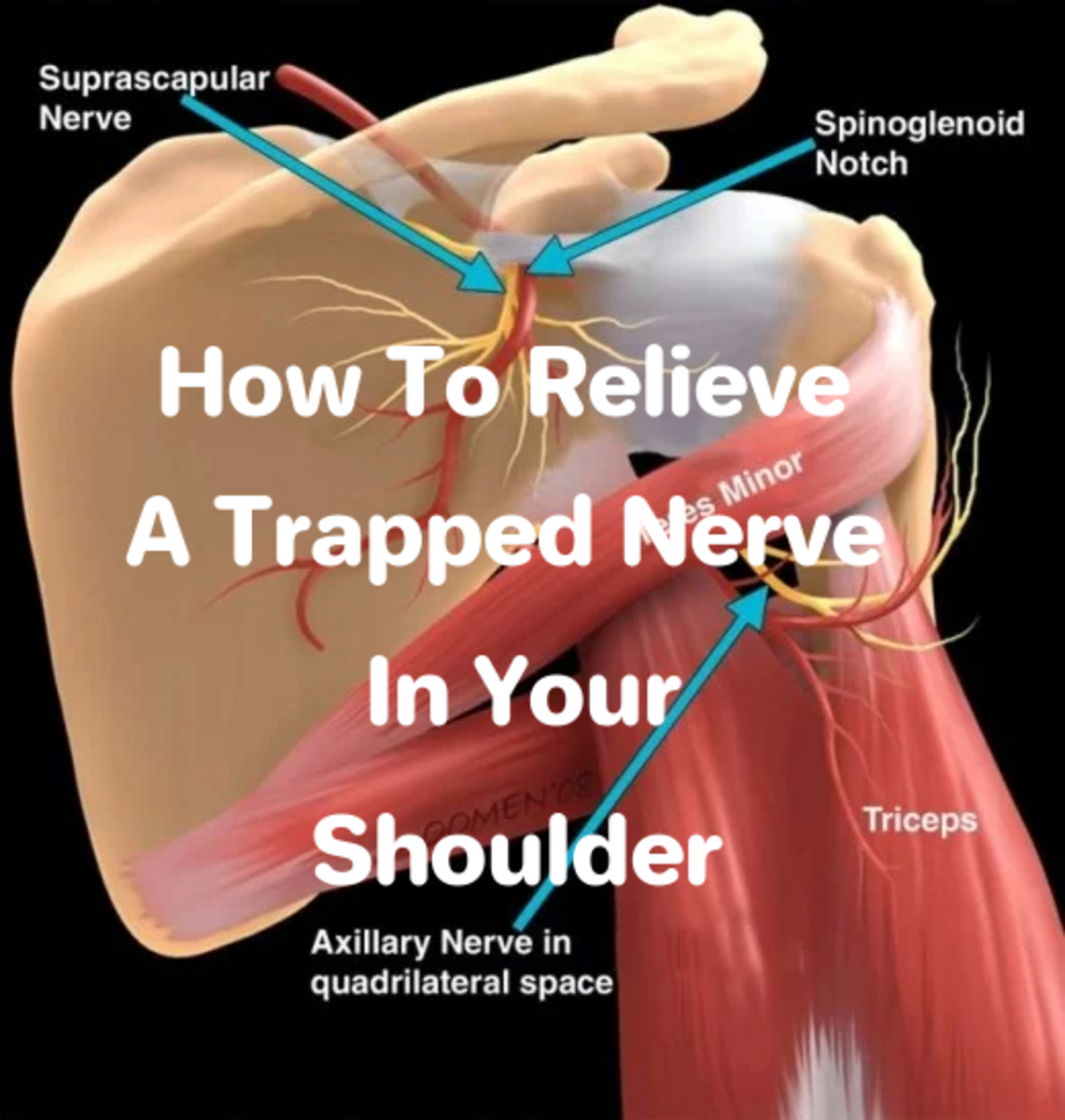 Trapped Nerve in shoulder. Relief, medication and exercise