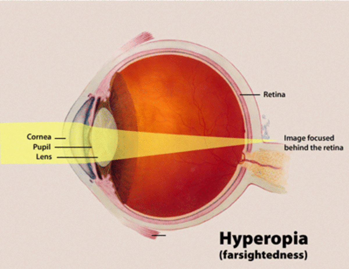 Hyperopia results in an image focused beyond the retina
