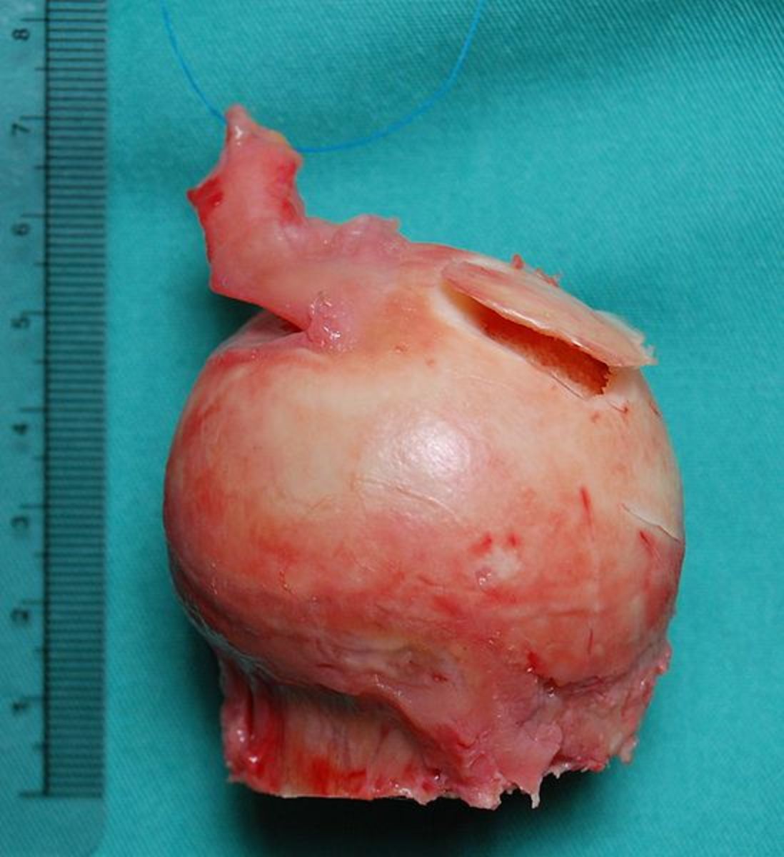 Femoral head affected by avascular necrosis and removed during hip replacement surgery